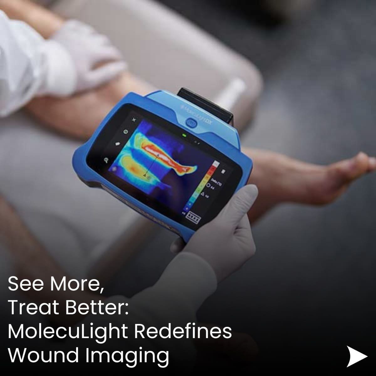 MolecuLight Unveils Advanced Multimodal Imaging with Thermal Capabilities at St. Louis Wound & Vascular Symposium